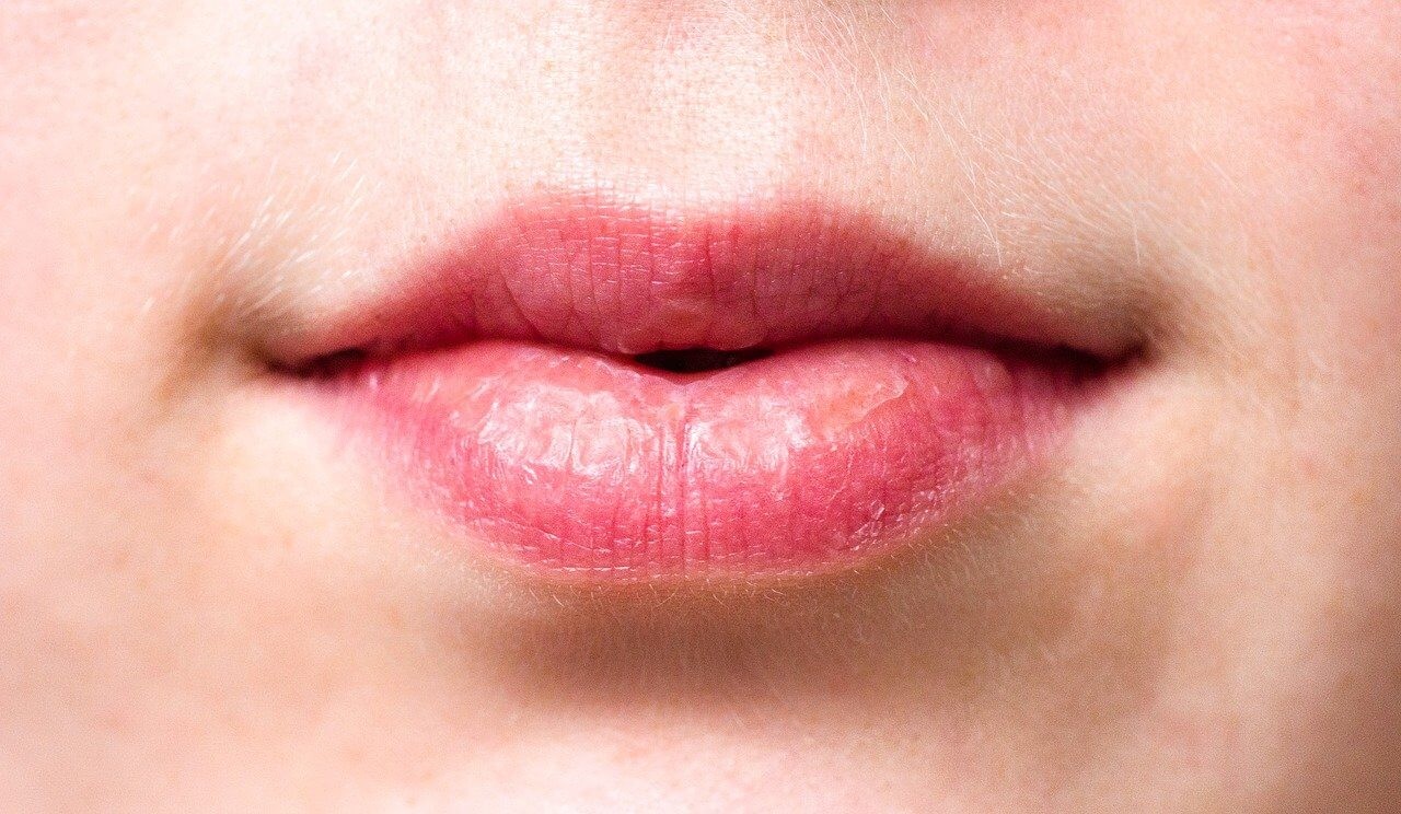 wrinkles-above-the-lips-the-best-treatments-prevention